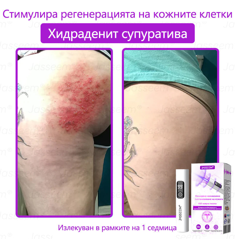 𝐉𝐚𝐬𝐬𝐞𝐞𝐦®✅ Усъвършенствана неинвазивна CO₂ лазерна писалка за грижа за кожата 💕(Нежно и ефективно премахва брадавици, бенки, старчески петна и кожни образувания – без болка и без усилие!) 📦