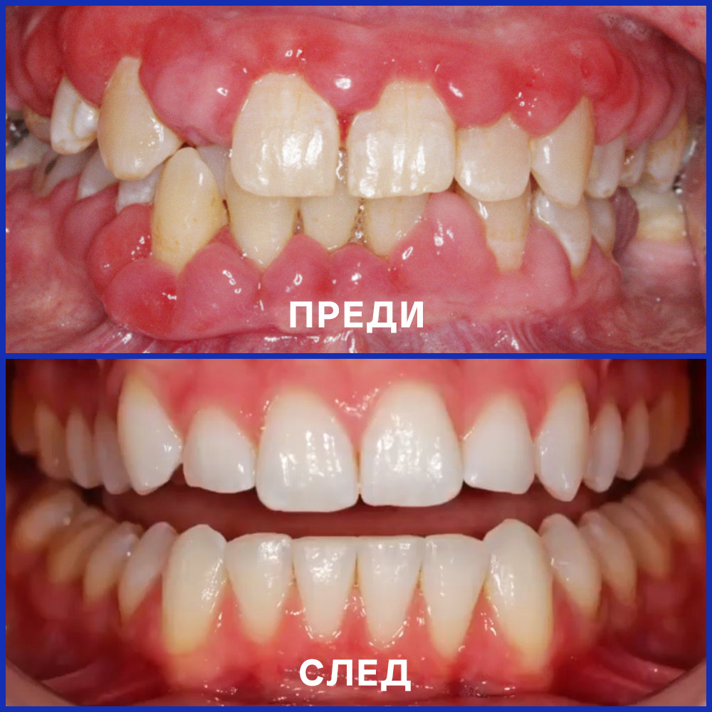 🦷Rolimey® VioGloss Дентална терапия с пчелна отрова Oral Power 🛒