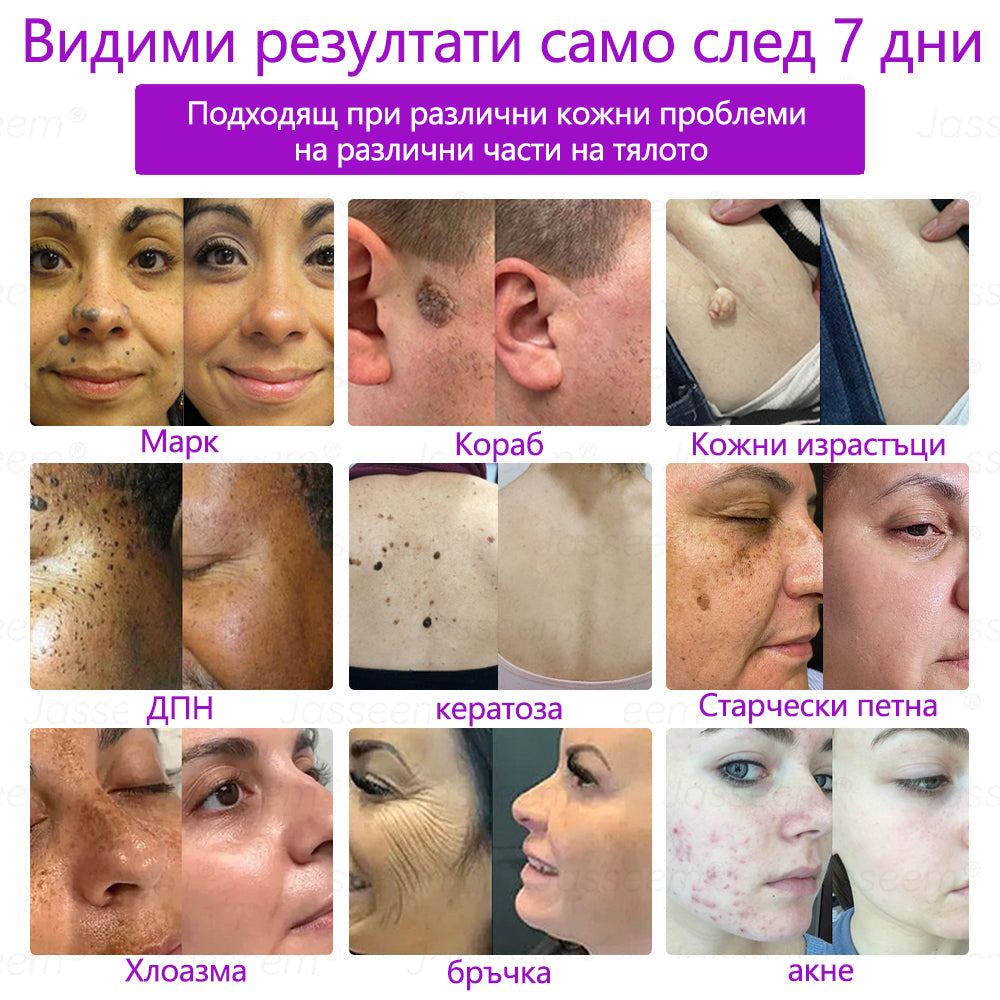𝐉𝐚𝐬𝐬𝐞𝐞𝐦®✅ Усъвършенствана неинвазивна CO₂ лазерна писалка за грижа за кожата 💕(Нежно и ефективно премахва брадавици, бенки, старчески петна и кожни образувания – без болка и без усилие!) 📦