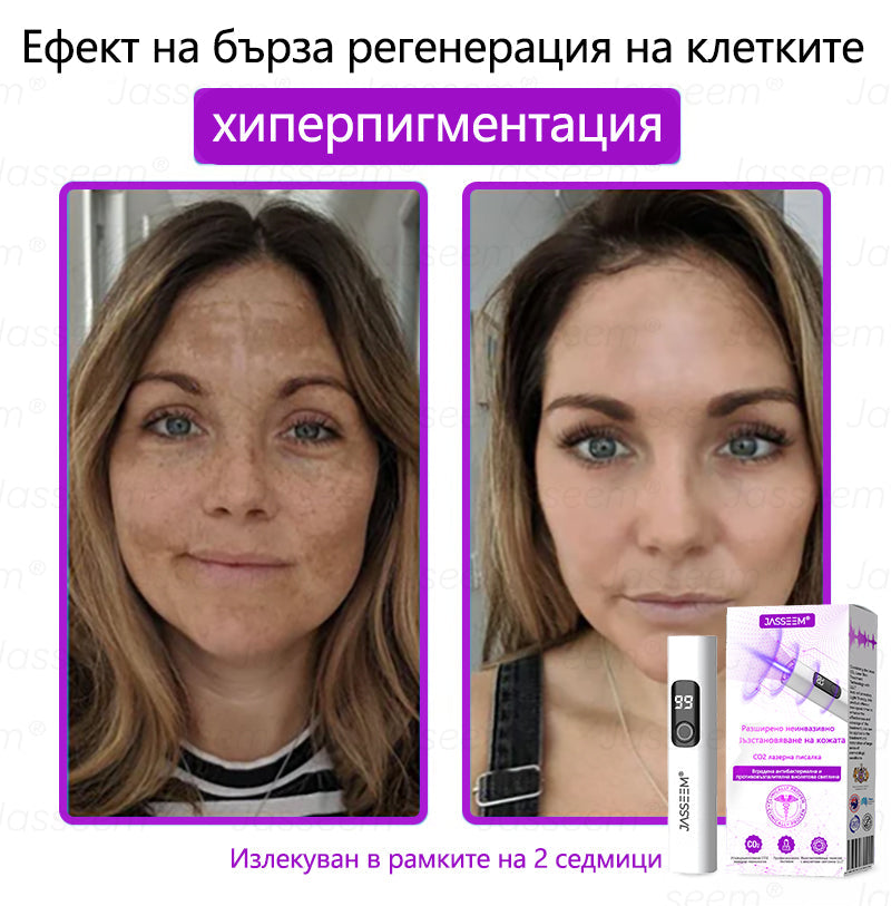 𝐉𝐚𝐬𝐬𝐞𝐞𝐦®✅ Усъвършенствана неинвазивна CO₂ лазерна писалка за грижа за кожата 💕(Нежно и ефективно премахва брадавици, бенки, старчески петна и кожни образувания – без болка и без усилие!) 📦