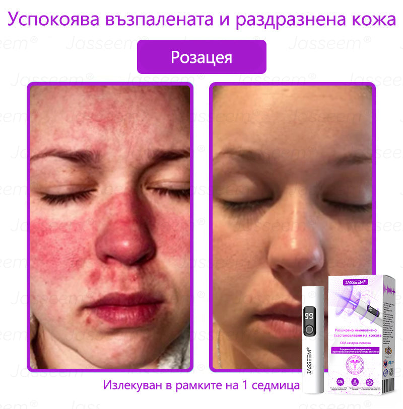 𝐉𝐚𝐬𝐬𝐞𝐞𝐦®✅ Усъвършенствана неинвазивна CO₂ лазерна писалка за грижа за кожата 💕(Нежно и ефективно премахва брадавици, бенки, старчески петна и кожни образувания – без болка и без усилие!) 📦