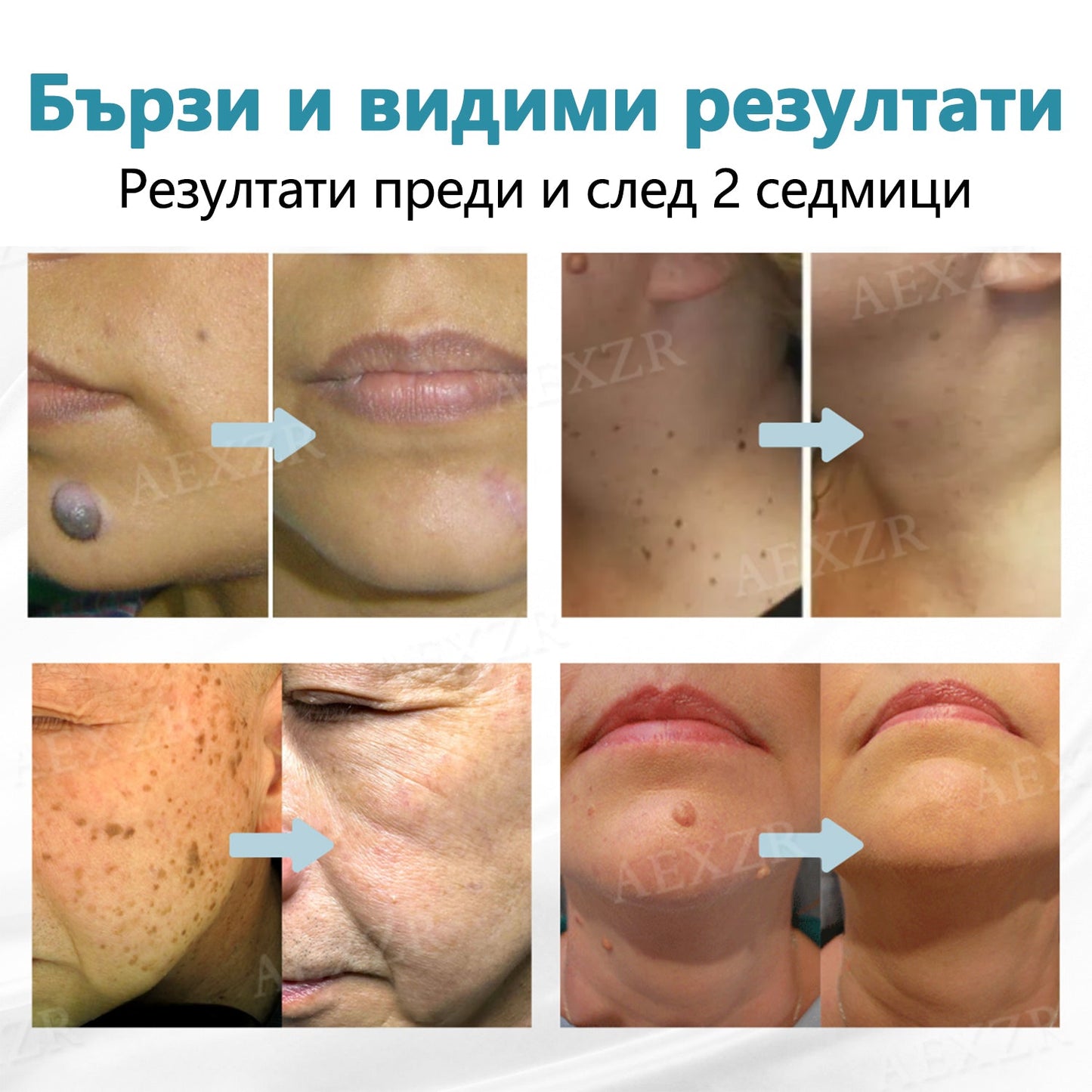 Bikenda®💎Неинвазивна лазерна писалка за премахване на бенки и брадавици  🛒