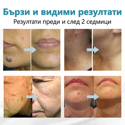 Bikenda®💎Неинвазивна лазерна писалка за премахване на бенки и брадавици  🛒