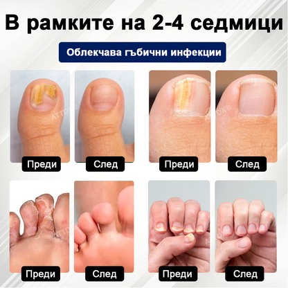 ATTDX® Fungiclear Пчелна Терапия Спрей за Нокти  🛒