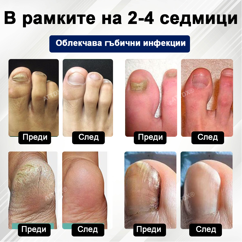 ATTDX® Fungiclear Пчелна Терапия Спрей за Нокти  🛒