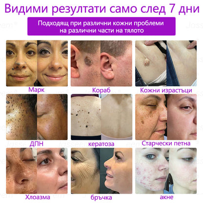 𝐉𝐚𝐬𝐬𝐞𝐞𝐦®✅ Усъвършенствана неинвазивна CO₂ лазерна писалка за грижа за кожата 💕(Нежно и ефективно премахва брадавици, бенки, старчески петна и кожни образувания – без болка и без усилие!) 📦