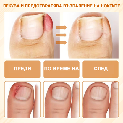 ATTDX® Fungiclear Пчелна Терапия Спрей за Нокти  🛒